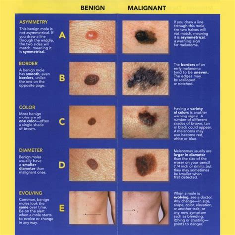 Five Warning Signs Of Skin Cancer Artofit
