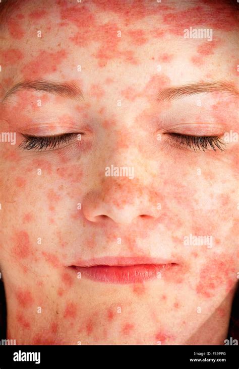 Young Woman With Skin Rash Stock Photo Alamy