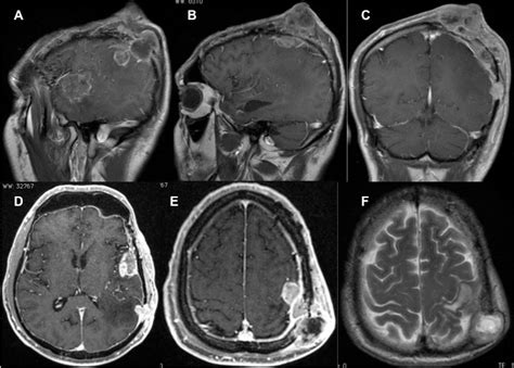 Mri At 3 Months After First Resection Of A Scalp Glioblastoma