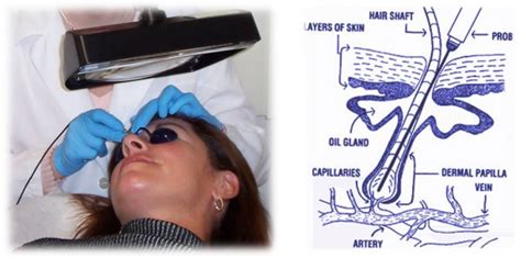 Laser hair removal for blonde hair: Electrolysis Program | Florida Medical & Aesthetic ...