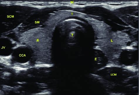The Normal Appearance Of The Thyroid Gland In The Ultrasonography