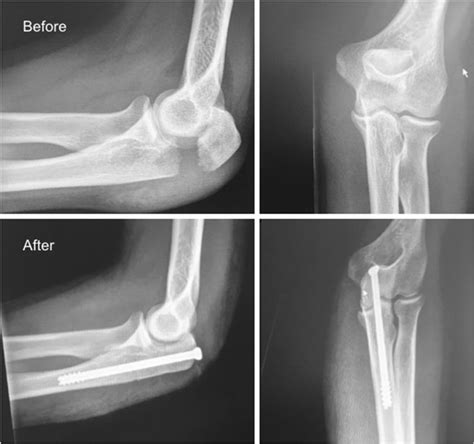 Displaced Simple Olecranon Fracture Before And After Fixation With A