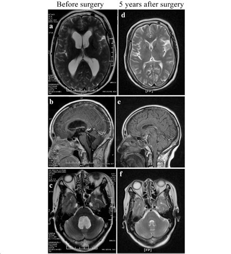 Preoperative A C And Postoperative D F Magnetic Resonance Imaging
