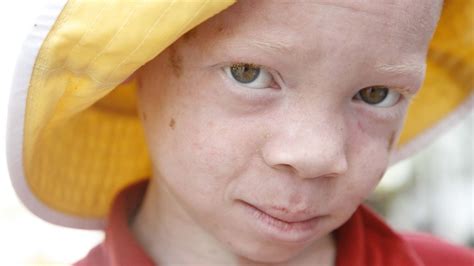 Malawi People With Albinism Are Hunted And Killed In The Name Of