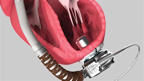 Medical Device Animation Heartware System Lvad Pump Medical