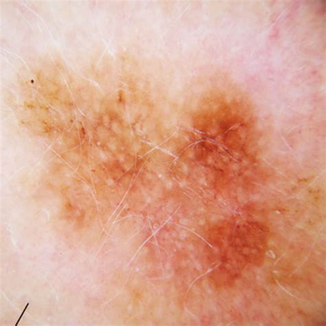 Skin Cancer Discoloration