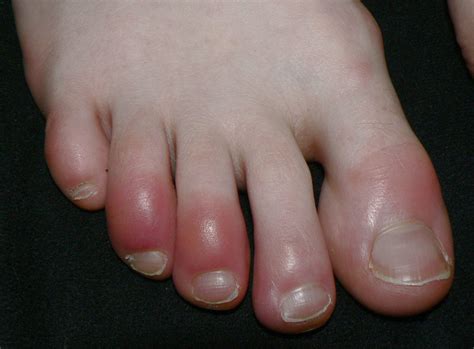 Chilblains In Miami Podiatry Miami