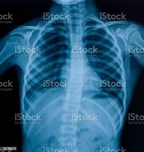 Xray Image Of Chest Stock Photo Download Image Now X Ray Image
