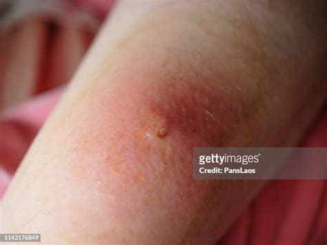 Boils On Skin Photos And Premium High Res Pictures Getty Images
