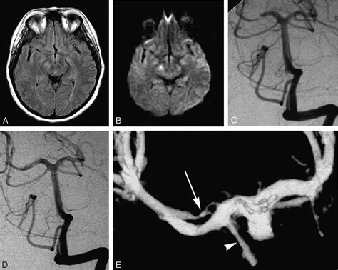 Fig 1 Isolated Posterior Cerebral Artery Dissection Report Of Three