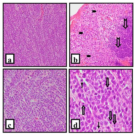 Cureus Primary Ovarian Non Hodgkins Lymphoma An 18 Year