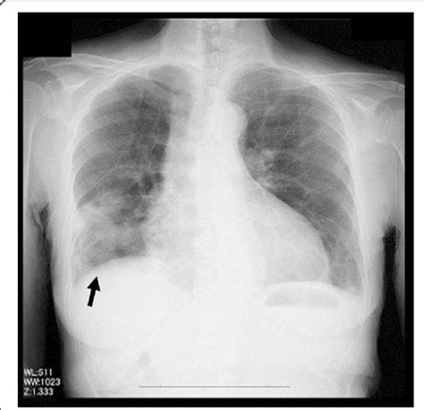 Chest X Ray Showing Enlarged Heart Associated With Infiltration Of Both