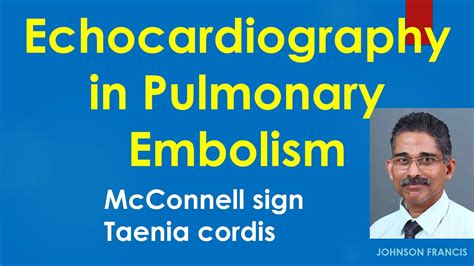 Echocardiography In Pulmonary Embolism Youtube