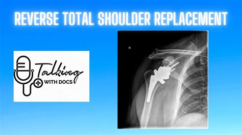 Reverse Total Shoulder Replacement Youtube