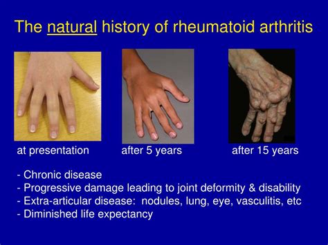 Rheumatoid Arthritis Life Expectancy Age Life Cake Gala
