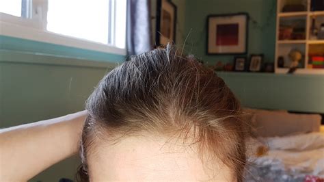 My Hairline Has Always Been Weird Like This Does Anyone Know If Any Tips Or Tricks To Make It