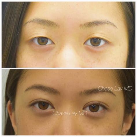 Asian Eyelid Surgery San Jose Double Lid Blepharoplasty San Francisco