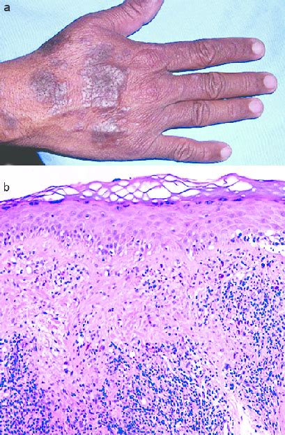 Case 2 A Erythemato Violaceous Papular Lesions On The Wrist And