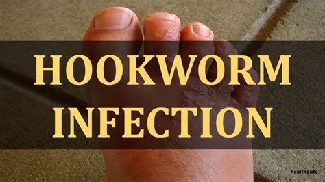 Hookworm Infection Youtube