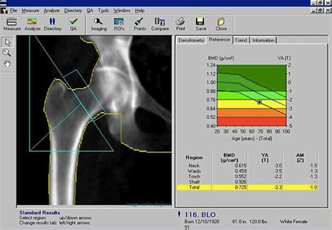 Why And How To Measure Bone Density Who Should Have A Dexa Scan