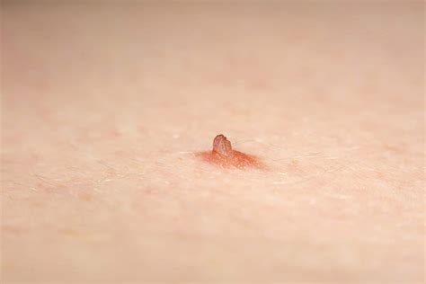 Vancouver Laser Mole Removal And Surgical Removal In Surrey Medical