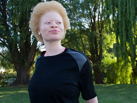 Albino Black People Telegraph