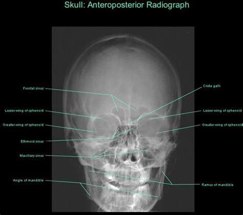The nasal bones are ossified intramembranously via the cartilaginous nasal capsule. Frontal radiograph of skull | Medical radiography, Anatomy ...