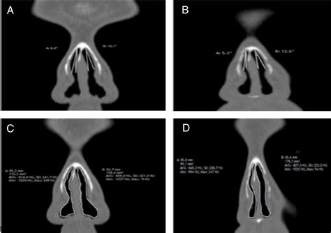 SciELO - Brasil - Computed tomography evaluation of internal nasal