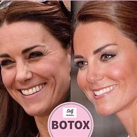 Give baby the bath in the evening so it calms him/her down and then put to sleep shortly after. Even a princess cannot resist a little Botox. Botox can be ...