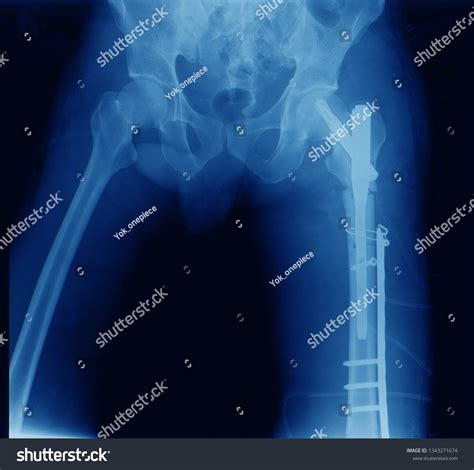 Anteroposterior Plain Radiograph Xray Hips Pelvis Stock Photo