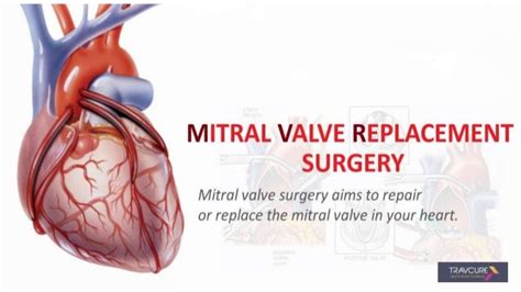 Mitral Valve Replacement Surgery In India