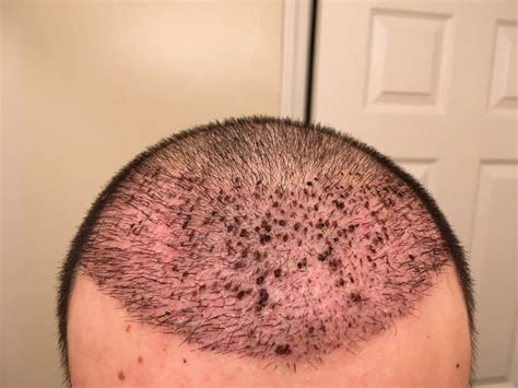 Scalp Inflammation And Redness Cosmedica Clinic Dr Acar
