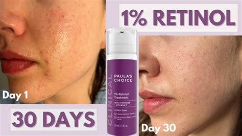 I Used Paulas Choice 1 Retinol Treatment On My Acne Scars For 30 Days