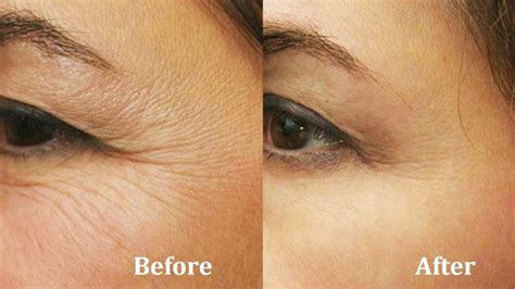 How To Reduce Wrinkles Without Pain And Surgery Wanderglobe