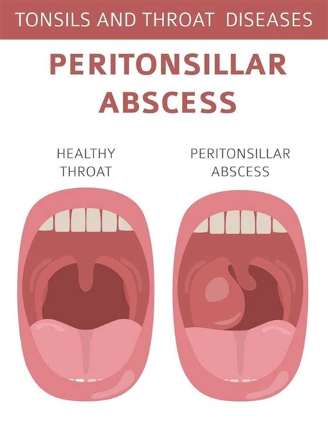 Tonsillitis Peritonsillar Abscess