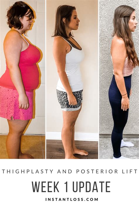 Thighplasty And Posterior Lift Week 1 Update