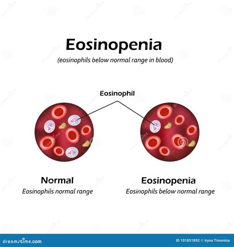 Eosinophils Below Normal Range In Blood Eosinopenia Infographics