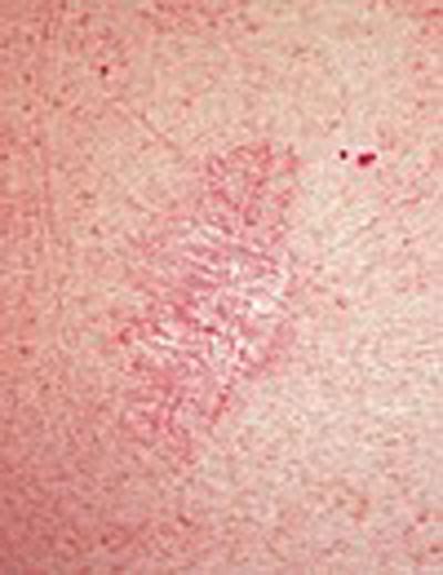 Warning Signs Of Skin Cancer On Leg Diabetic Dermopathy More Than