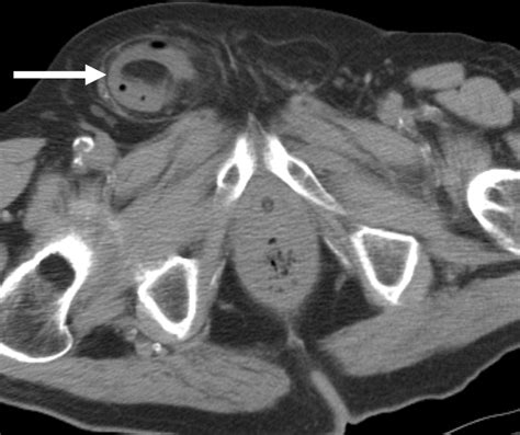 Abdominal Wall Hernias Imaging Features Complications And Diagnostic