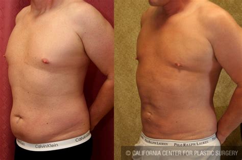 Patient 5651 Male Liposuction Abdomen Before And After Photos Beverly