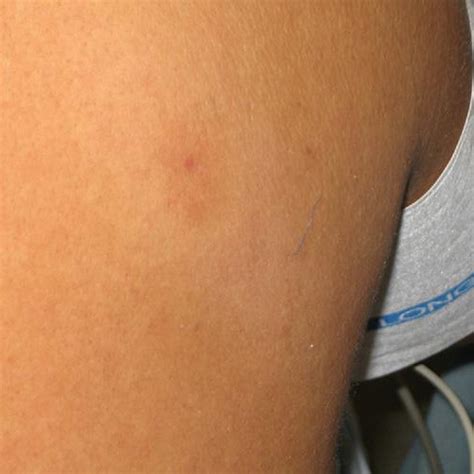 An Example Of A Black Widow Spider Bite Showing An Oval Targetlike