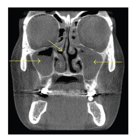 Dividing the nostrils and nasal passages is the nasal septum, a wall made up of cartilage and very often, the issue can be fixed without any outwardly noticeable changes, but when the deviation is. Coronal CT scan demonstrating right nasal septal deviation ...