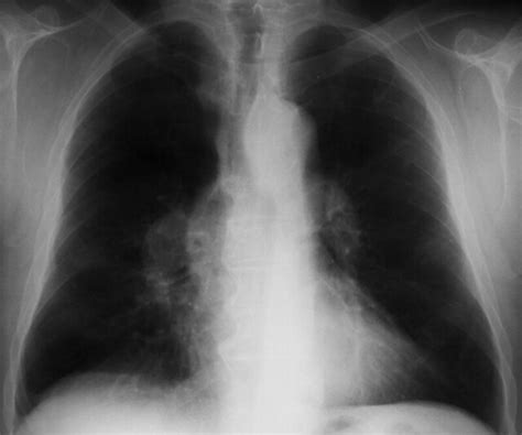 Pulmonary Hypertension Cxr Frontal Enlarged Pulmonary Ar Flickr