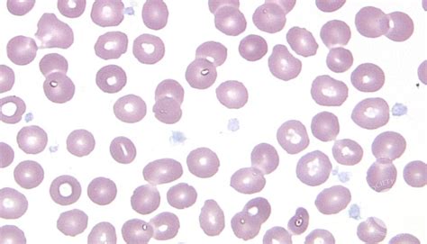 Gray Platelet Syndrome