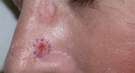 Basal Cell Carcinoma Bcc Acd
