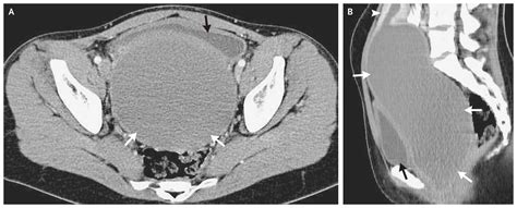 Imperforate Hymen With Hematocolpometra With Images Medical Facts