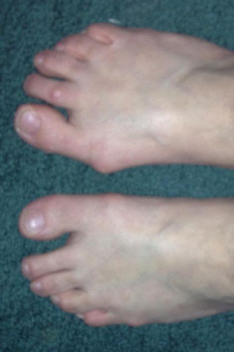 This Is What Rheumatoid Arthritis Has Done To My Poor Feet My Right