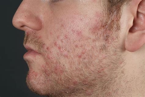 Folliculitis Causes Pictures Photos