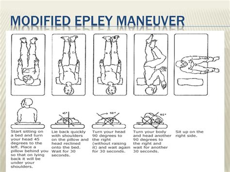 Left Sided Epley Maneuver