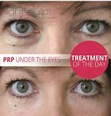 Prp Eye Treatment Images